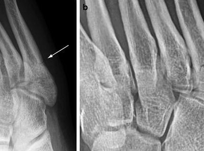 running foot stress fracture