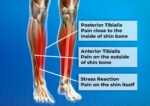 How to Get Rid of Shin Splints: Treat and Fully Recover