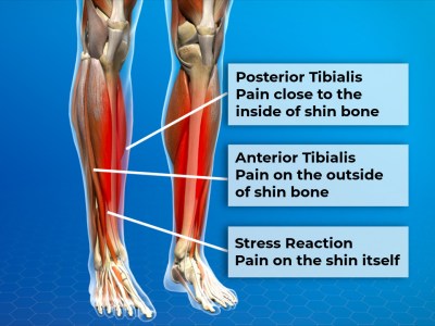 Shin Splints in Runners