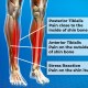 Shin Splints in Runners