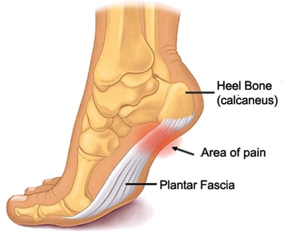 What Makes The Best Shoes For Plantar Fasciitis?