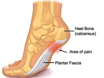 plantar fasciitis running