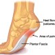 plantar fasciitis running