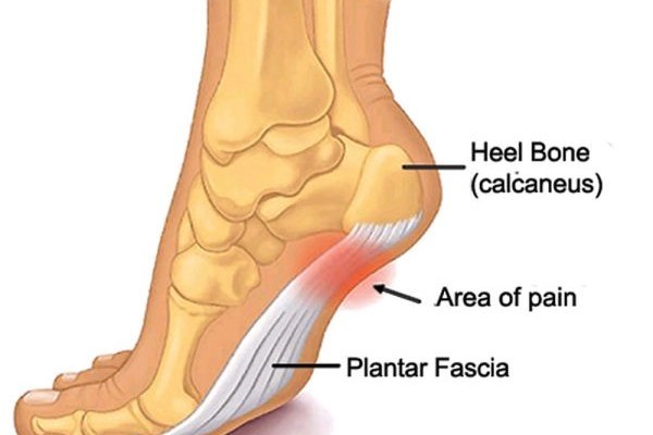 plantar fasciitis running