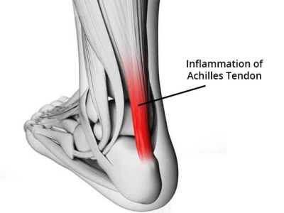 achilles running pain