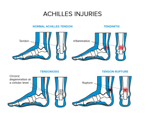 Achilles Pain When Running: Common Causes and Best Shoes