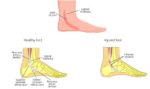 Peroneal Tendonitis: Runners' Treatment and Prevention Guide