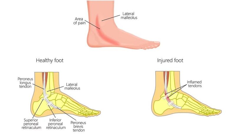 Peroneal Tendonitis: Runners' Treatment and Prevention Guide