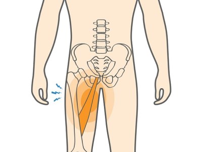 Groin pain running