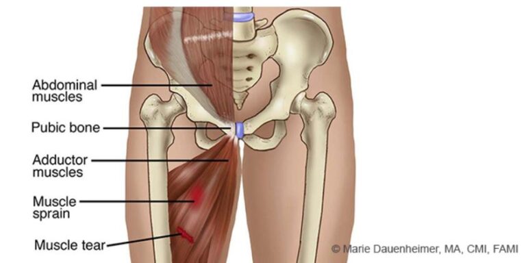 Groin Pain After Running 9 Causes Treatments And Prevention