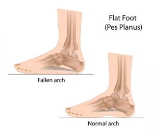 8 Exercises and Tips for Running With Flat Feet (Video)