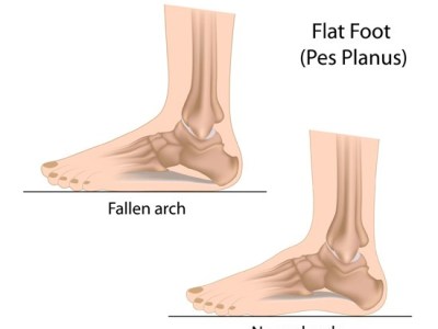 Running with Flat Feet