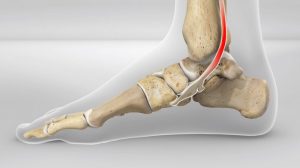 Posterior Tibal Tendonitis Running