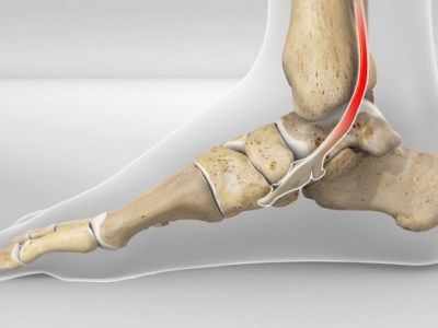 Posterior Tibal Tendonitis Running