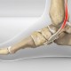 Posterior Tibal Tendonitis Running