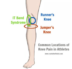 Treatment for Runner’s Knee vs. Jumper’s Knee