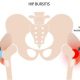 hip bursitis running