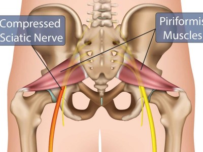 sciatic pain in runners