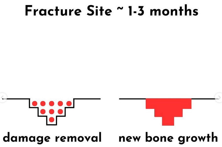 fracture repair