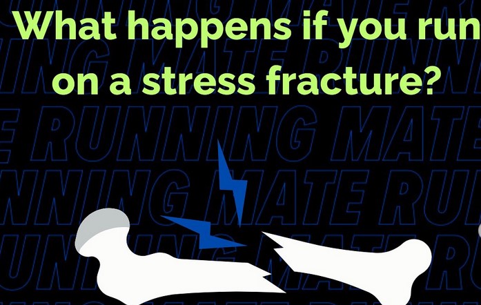 Stress Fractures in Runners (Vs Stress Reactions)